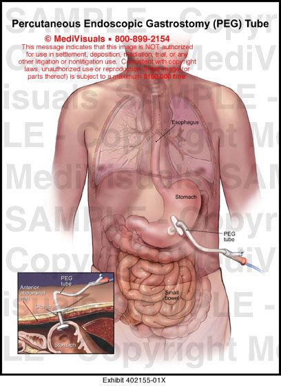 Medivisuals Percutaneous Endoscopic Gastrostomy Peg Tube