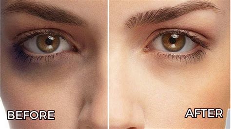 Remove Dark Circles In 1 Week Best Home Remedy 100 Natural