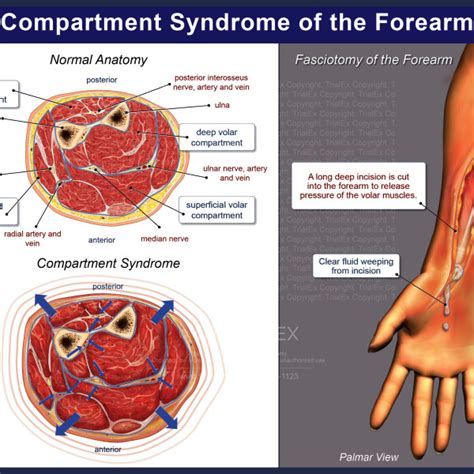 Compartment Syndrome Of The Forearm Trialexhibits Inc