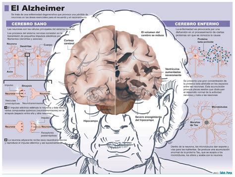 Enfermedad De Alzheimer Olvidarlo Todo Todo Todo Salud Ediciones
