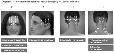 Pin On Migraine Disease