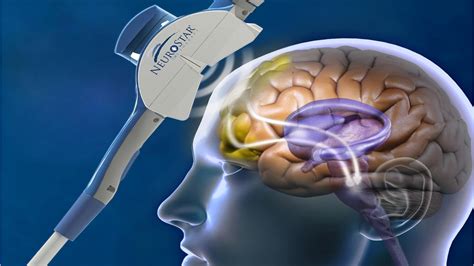 How Neurostar Tms Therapy Works Tranquility Tms Center