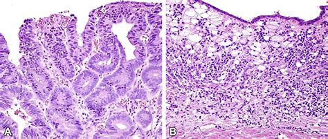 Clinical Predictors Of Histologic Type Of Gastric Cancer