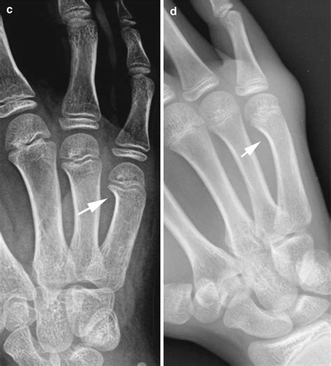 Wrist And Hand Radiology Key