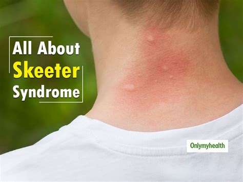 Know About Skeeter Syndrome Allergic Reaction To Mosquito Bites