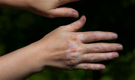 Vitiligo In Kids All You Need To Know About It Health Watch