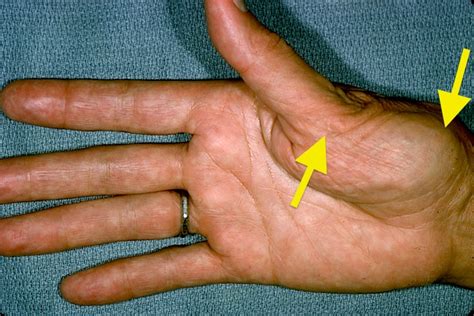 Osteoarthritis Carpometacarpal Cmc Joint Of Thumb Hand Surgery