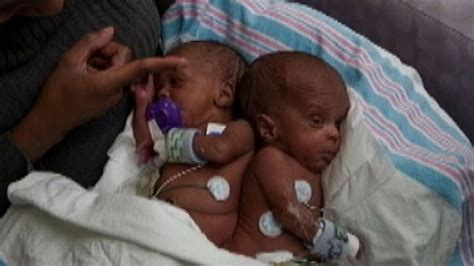 Chicago Area Woman Gives Birth To Conjoined Twin Girls Abc News