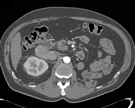 Renal Cell Carcinoma Metastatic To Contralateral Adrenal Adrenal Case