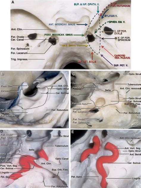 Cavernous Sinus The Neurosurgical Atlas