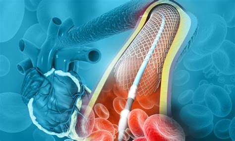 Angioplasty Stent Placement Open Block Arteries