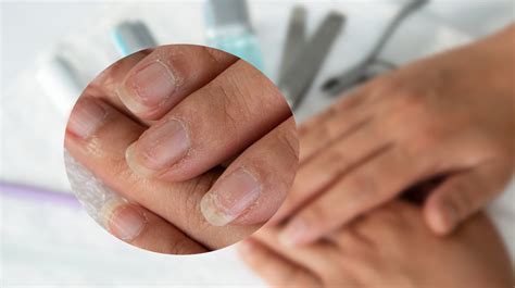Peeling Nails Causes Treatment And Prevention Ph
