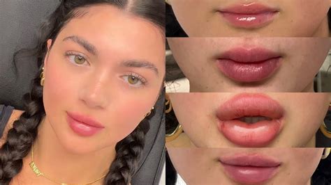 I Got My Lip Filler Dissolved 3 Times And Refilled Before During And After Omg Youtube