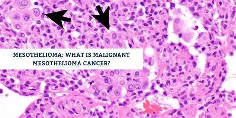 Mesothelioma What Is Malignant Mesothelioma Cancer