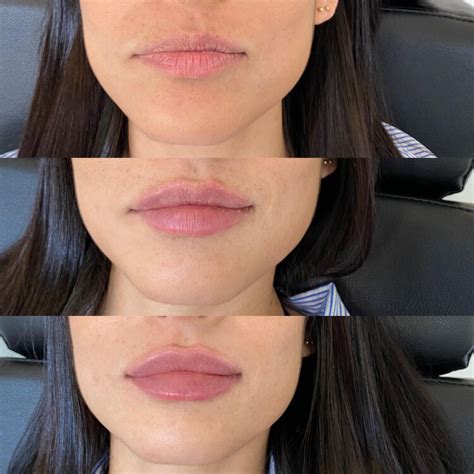 6 Volbella Lips 1 Syringe Reshnapercy