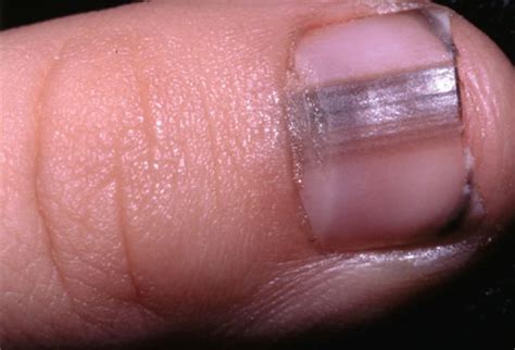 What Your Fingernails Say About Your Health
