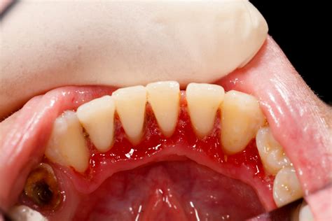 How To Reverse Gum Disease Jenson Dental