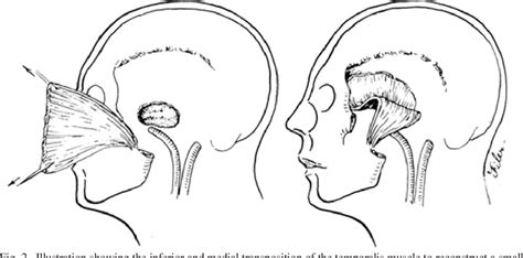 Figure 2 From Reconstruction Of The Skull Base After Tumor Resection