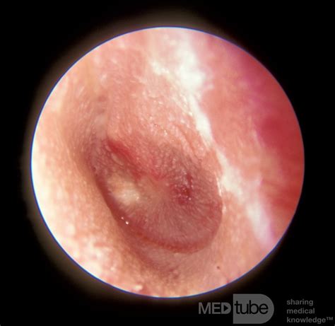 Pinhole Perforation From Acute Otitis Media • Picture •