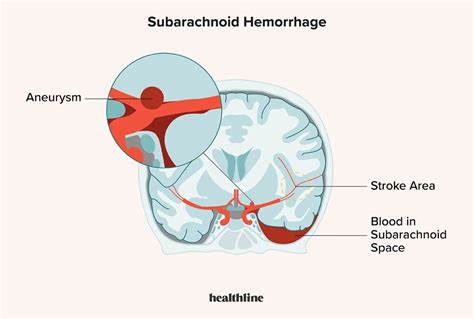 Subarachnoid Hemorrhage Symptoms Causes And Risk Factors