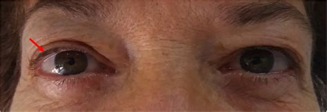 Bilateral Proptosis With Retraction Of The Upper Eyelid More