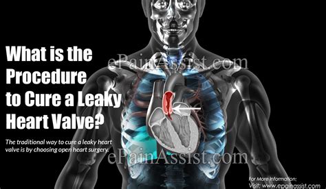 What Is The Procedure To Cure A Leaky Heart Valve