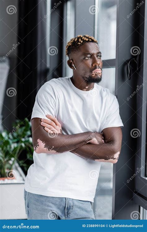 African American Man With Vitiligo Skin Stock Photo Image Of Wireless