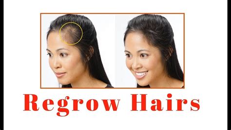 Regrow Hair Naturally In 21 Days Youtube