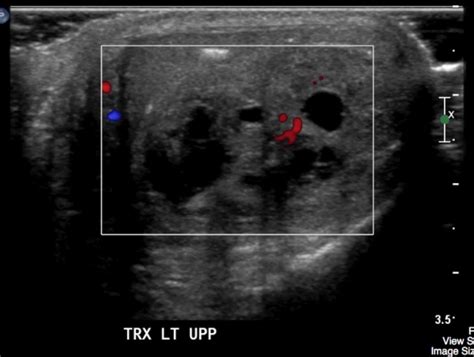 Testicular Choriocarcinoma Ultrasound