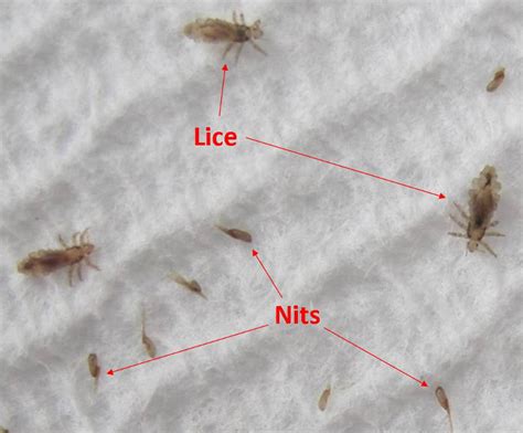 Head Lice Story In Pictures Licedoctors