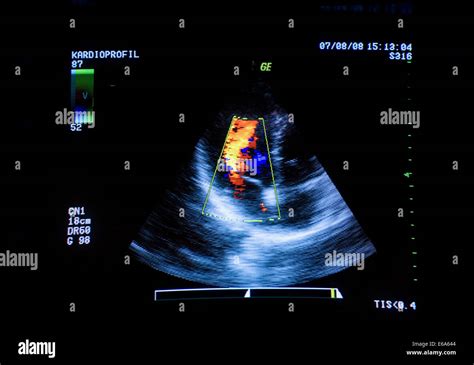 Cardiac Ultrasounds High Resolution Stock Photography And Images Alamy