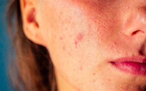What Causes Acne Papules And How Are They Treated