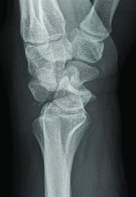 Lateral Radiograph Of A Dorsal Perilunate Fracturedislocation Download Scientific Diagram