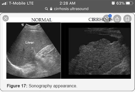 Pin By Mamimelly👅💦 On Liver Sonography Ultrasound Cirrhosis
