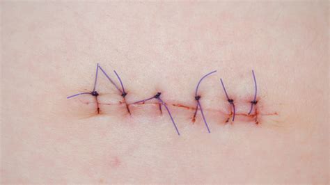 How Long Does It Take For Stitches To Dissolve 5 Tips For Healing