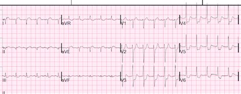 Dr Smiths Ecg Blog St Elevation In Avl With Reciprocal St Depression
