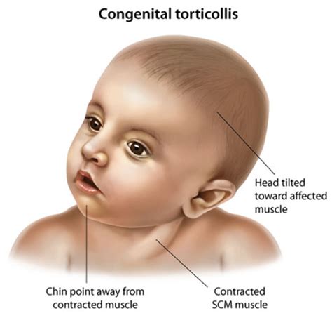 Torticollis And Plagiocephaly Differential Dx Flashcards Quizlet