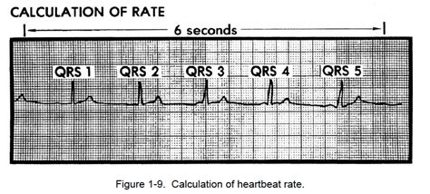 How To Calculate Heart Rate From Ecg With Regular Rhythm Photos Idea