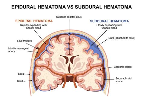 Explain The Difference Between Epidural And Subdural Hematomas