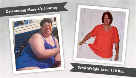 Before And After Rny With Mary J Losing 140 Pounds Obesityhelp