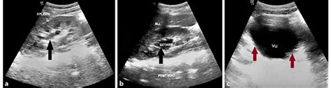 Urinary Bladder Ultrasound