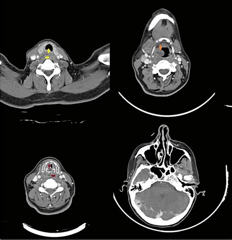 Axial Contrast Enhanced Ct Scan Of The Neck Depicts Soft Tissue
