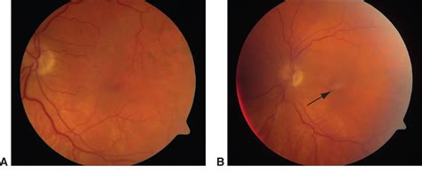 Posterior Vitreous Detachment American Academy Of Ophthalmology