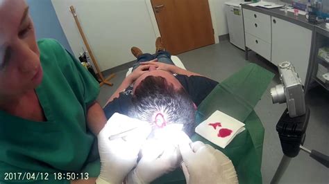 Scalp Cyst Removal Youtube