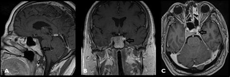 Cureus Metastatic Disease To Clivus Biopsy Or Not