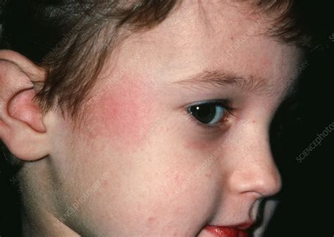 Fifth Disease Slapped Cheek Mark On Boy Stock Image M1600007