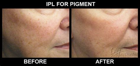 Ipl Fotofacial Before And After Photos Pittsburgh Pa