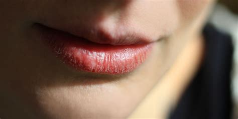 Dry Peeling Lips Can Actually Be A Sign Of More Serious Health Condition