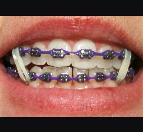 Purple Braces Power Chain Braces Rubber Bands Braces Bands Braces