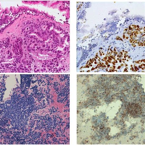 A Presence Of Lung Adenocarcinoma In The Bronchial Biopsy Staining Download Scientific